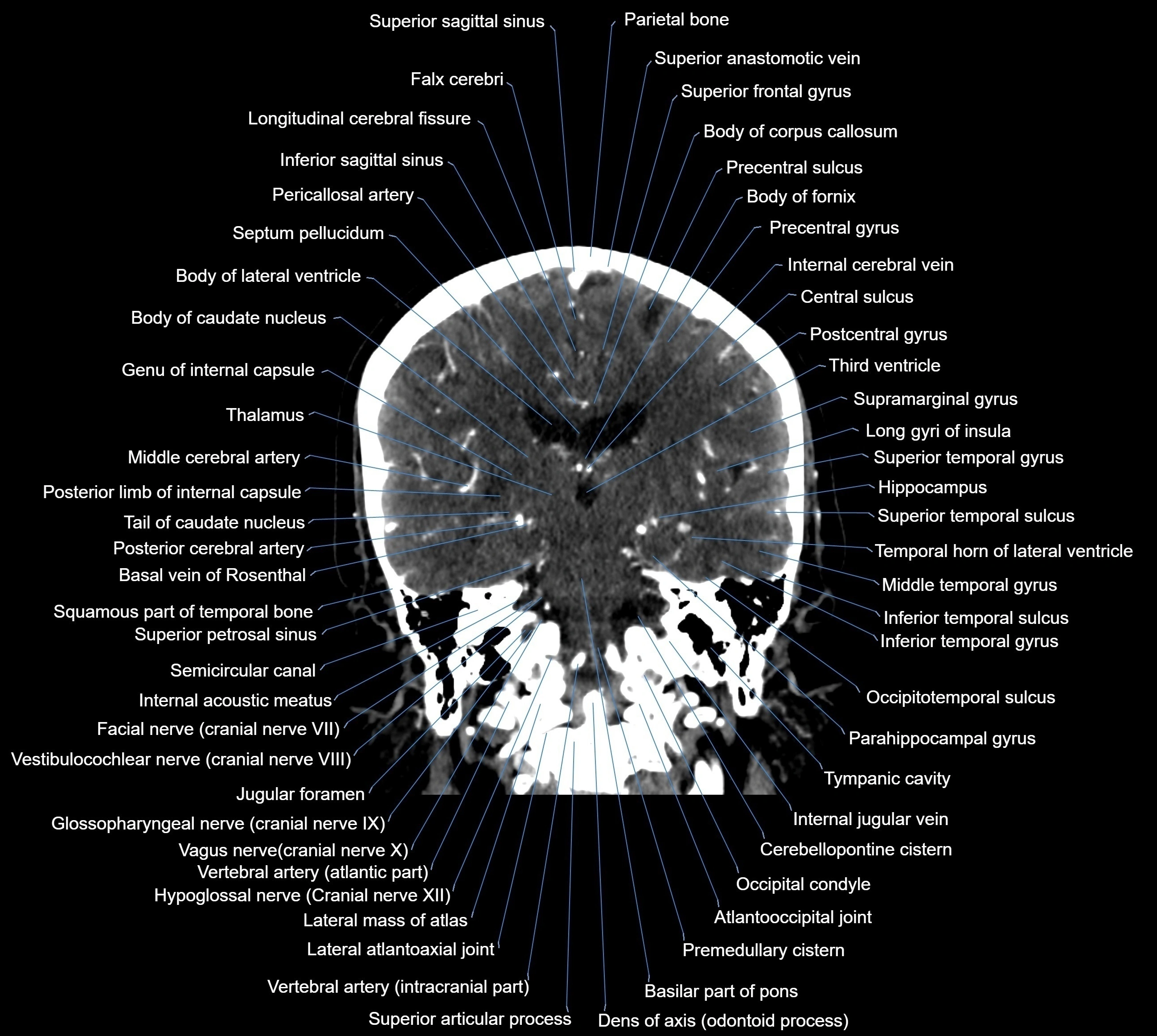 CT Brain coronal cross sectional radiology anatomy image  -img-00001-027.webp